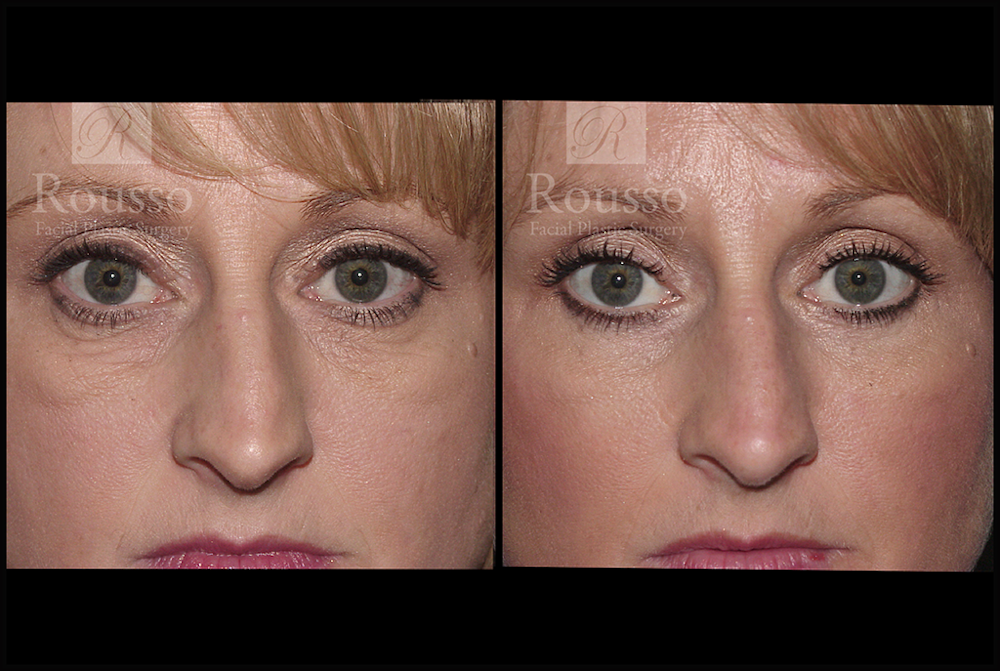 Blepharoplasty <span class=small>By Dr. Daniel Rousso</span> Before & After Gallery - Patient 3262170 - Image 1