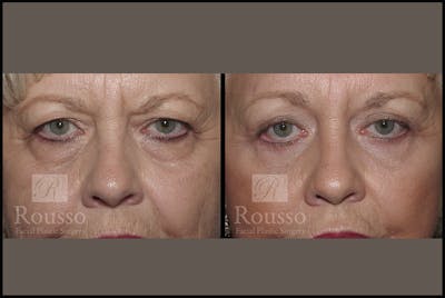 Blepharoplasty <span class=small>By Dr. Daniel Rousso</span> Before & After Gallery - Patient 3262200 - Image 1
