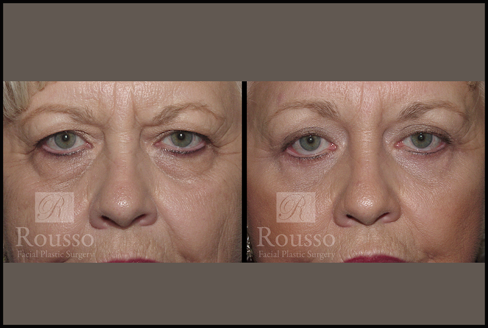 Blepharoplasty <span class=small>By Dr. Daniel Rousso</span> Before & After Gallery - Patient 3262200 - Image 1