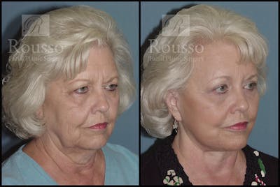 Blepharoplasty <span class=small>By Dr. Daniel Rousso</span> Before & After Gallery - Patient 3262200 - Image 2