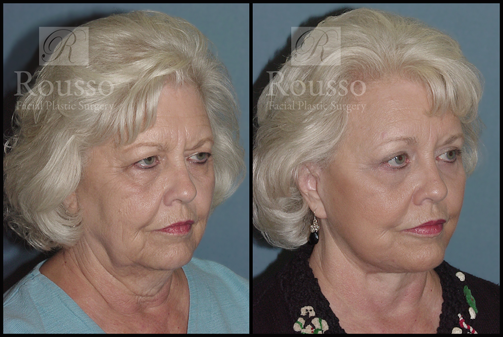 Blepharoplasty <span class=small>By Dr. Daniel Rousso</span> Before & After Gallery - Patient 3262200 - Image 2