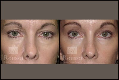 Blepharoplasty Before & After Gallery - Patient 3262269 - Image 1