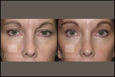 Blepharoplasty <span class=small>By Dr. Daniel Rousso</span> Before & After Gallery - Patient 3262269 - Image 1