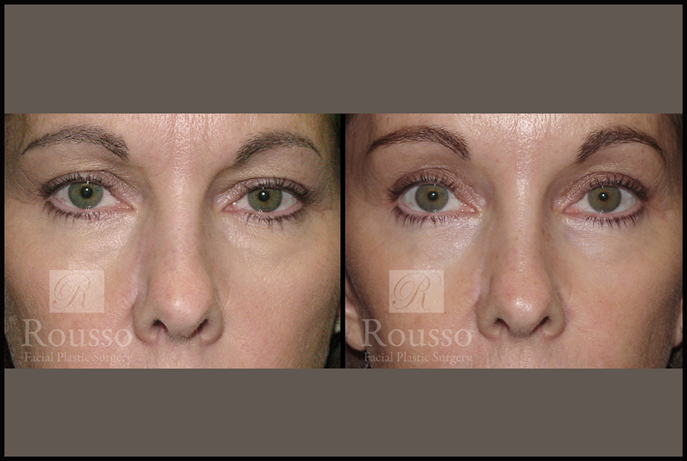 Blepharoplasty <span class=small>By Dr. Daniel Rousso</span> Before & After Gallery - Patient 3262269 - Image 1