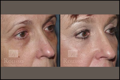 Blepharoplasty <span class=small>By Dr. Daniel Rousso</span> Before & After Gallery - Patient 3262270 - Image 1