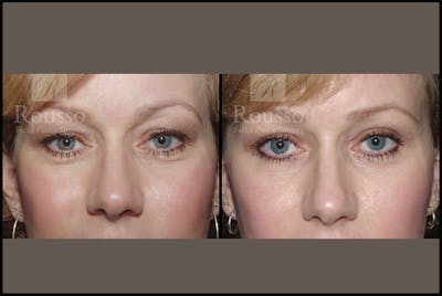 Blepharoplasty <span class=small>By Dr. Daniel Rousso</span> Before & After Gallery - Patient 3262271 - Image 1