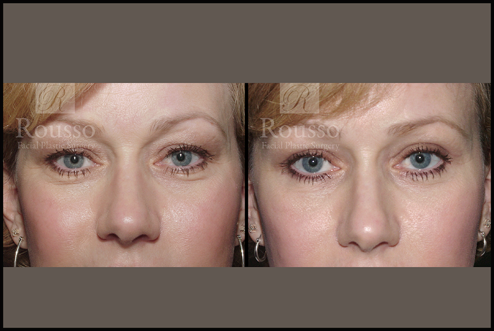Blepharoplasty Before & After Gallery - Patient 3262271 - Image 1