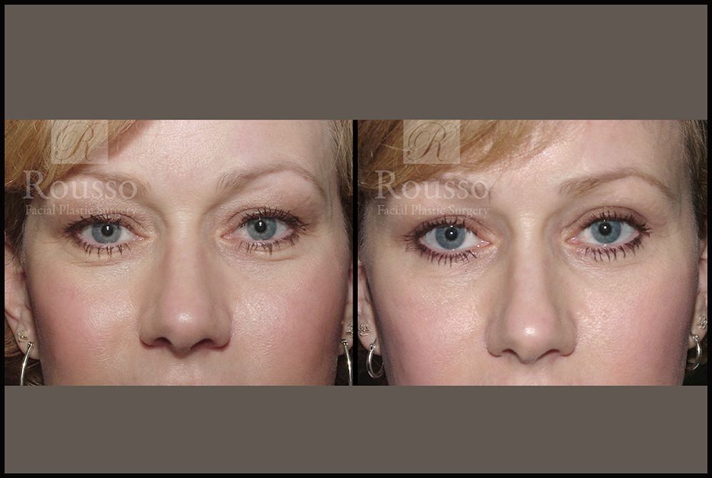 Blepharoplasty <span class=small>By Dr. Daniel Rousso</span> Before & After Gallery - Patient 3262271 - Image 1