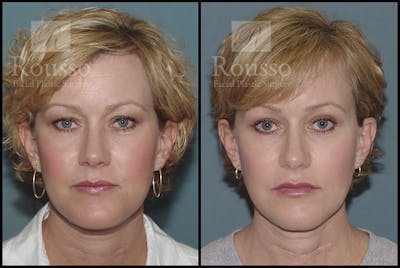 Blepharoplasty <span class=small>By Dr. Daniel Rousso</span> Before & After Gallery - Patient 3262271 - Image 2