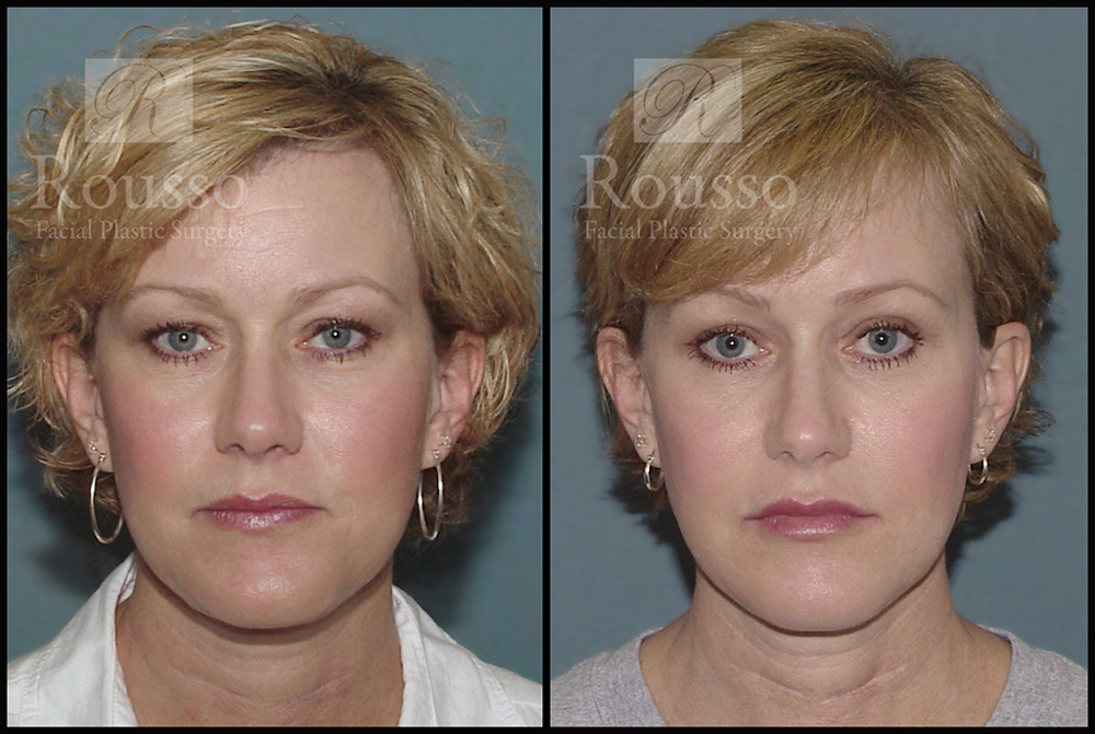 Blepharoplasty <span class=small>By Dr. Daniel Rousso</span> Before & After Gallery - Patient 3262271 - Image 2