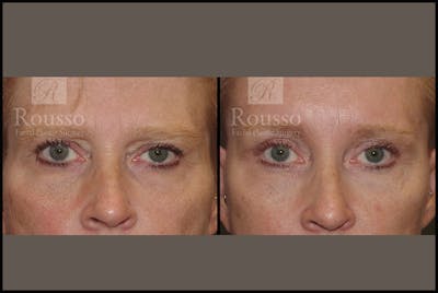 Blepharoplasty Before & After Gallery - Patient 3374125 - Image 1