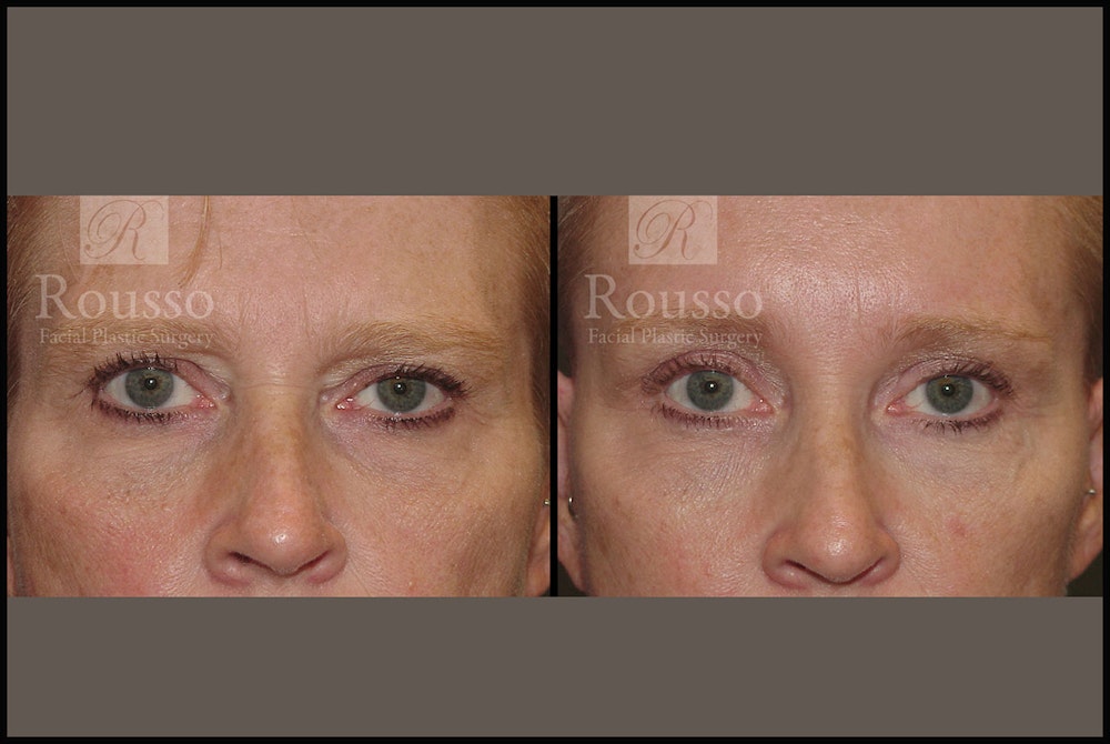 Blepharoplasty Before & After Gallery - Patient 3374125 - Image 1