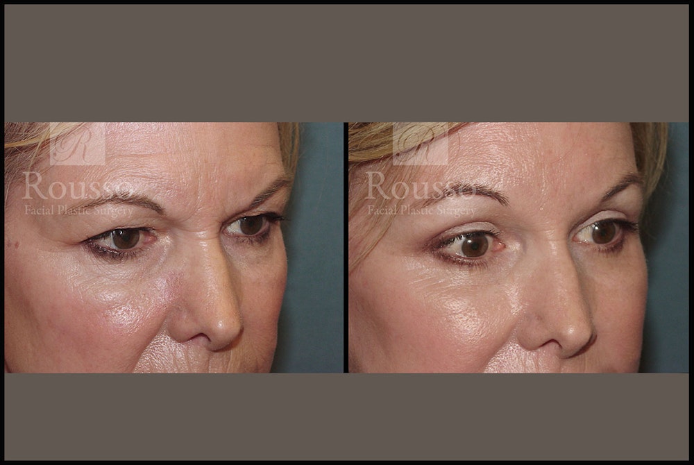 Blepharoplasty Before & After Gallery - Patient 3374125 - Image 2