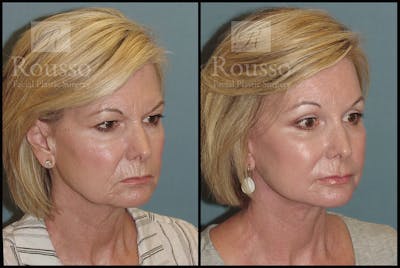 Facelift Before & After Gallery - Patient 3374262 - Image 1