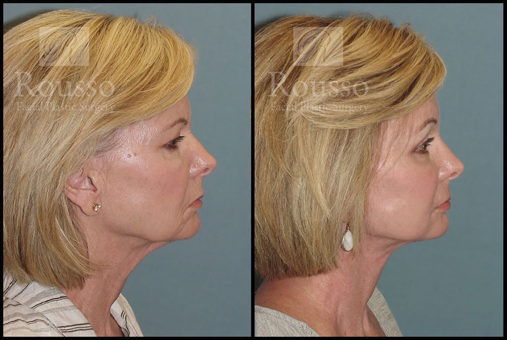 Facelift Before & After Gallery - Patient 3374262 - Image 2