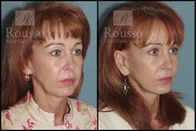 MiniLift <span class=small>By Dr. Daniel Rousso</span> Before & After Gallery - Patient 3549172 - Image 2