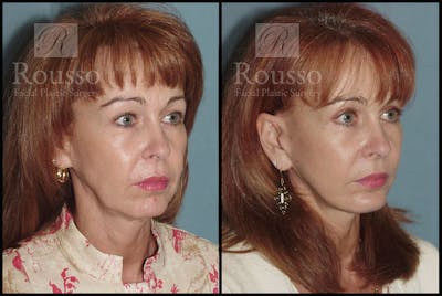 MiniLift Before & After Gallery - Patient 3549172 - Image 2