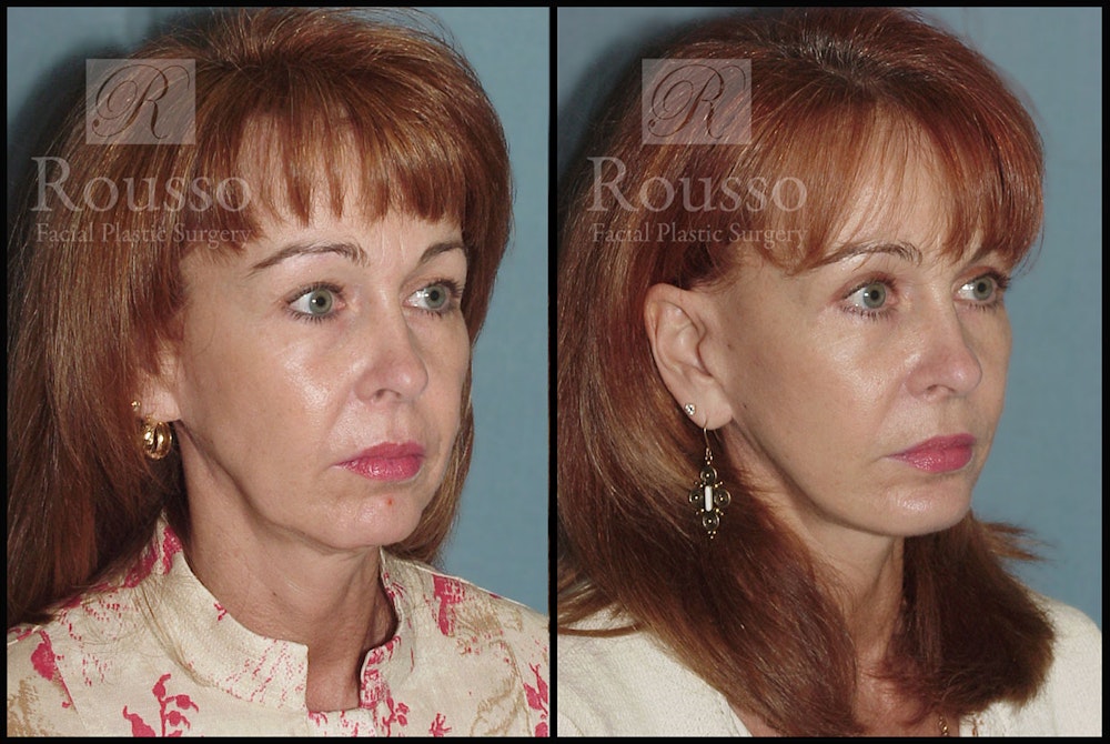 MiniLift Before & After Gallery - Patient 3549172 - Image 2