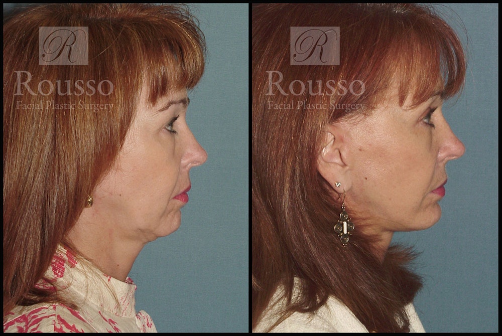 MiniLift <span class=small>By Dr. Daniel Rousso</span> Before & After Gallery - Patient 3549172 - Image 3