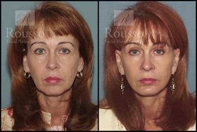 MiniLift <span class=small>By Dr. Daniel Rousso</span> Before & After Gallery - Patient 3549172 - Image 1