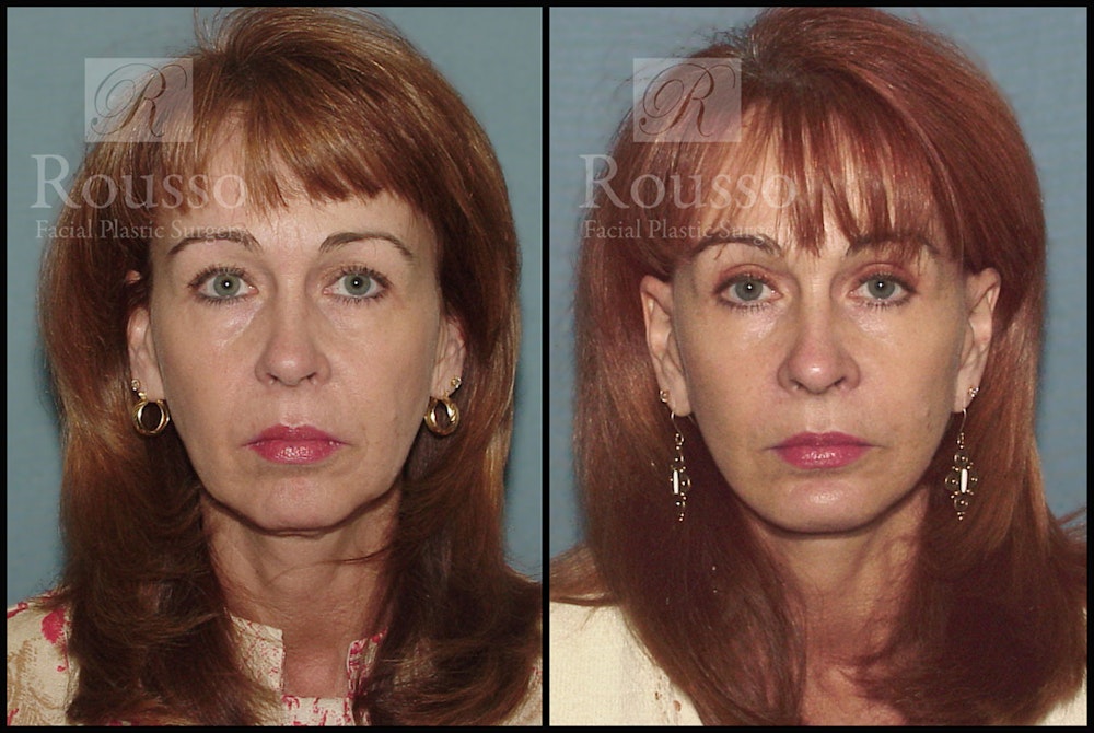 MiniLift <span class=small>By Dr. Daniel Rousso</span> Before & After Gallery - Patient 3549172 - Image 1