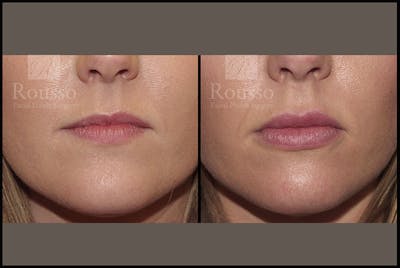 Fillers Before & After Gallery - Patient 4009382 - Image 1
