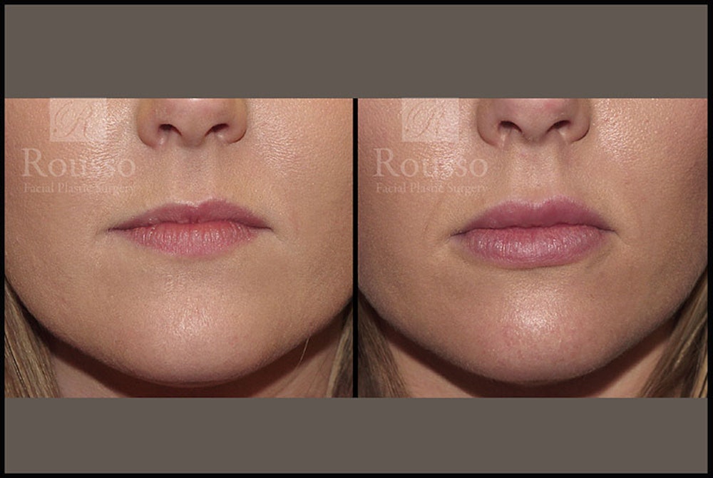 Fillers Gallery Before & After Gallery - Patient 4009382 - Image 1