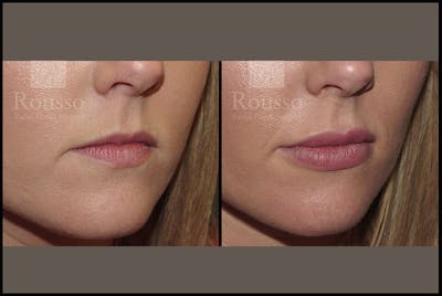 Fillers Gallery Before & After Gallery - Patient 4009382 - Image 2