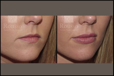 Fillers Before & After Gallery - Patient 4009382 - Image 2
