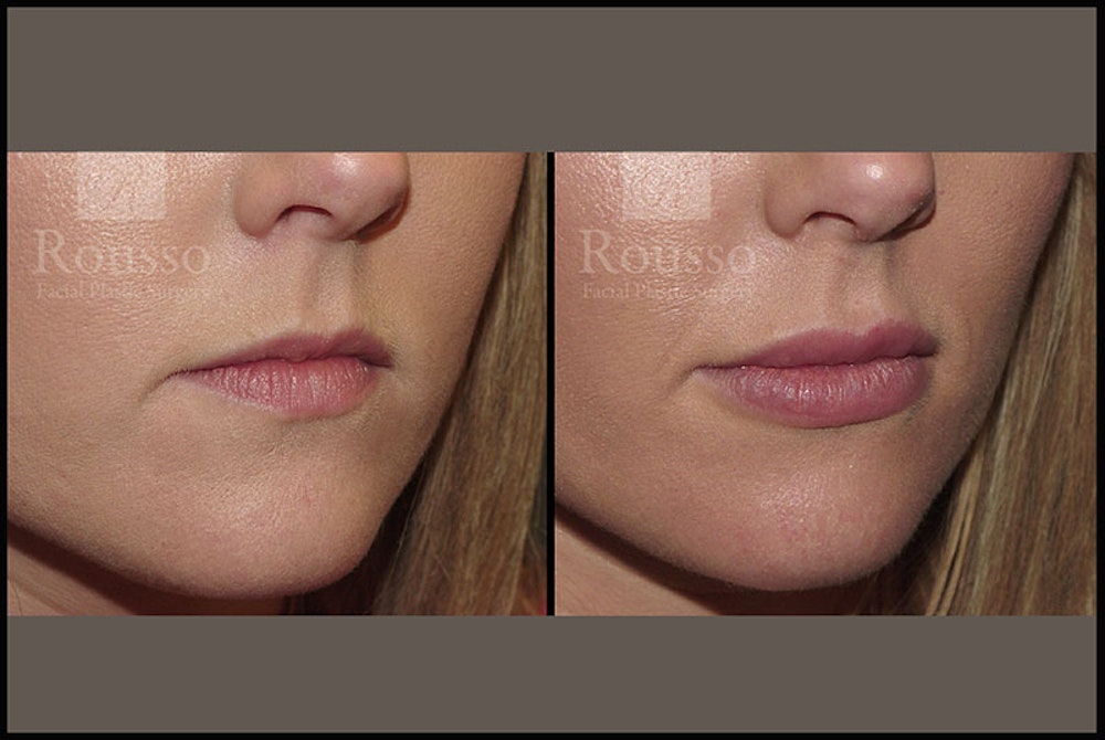 Fillers Gallery Before & After Gallery - Patient 4009382 - Image 2