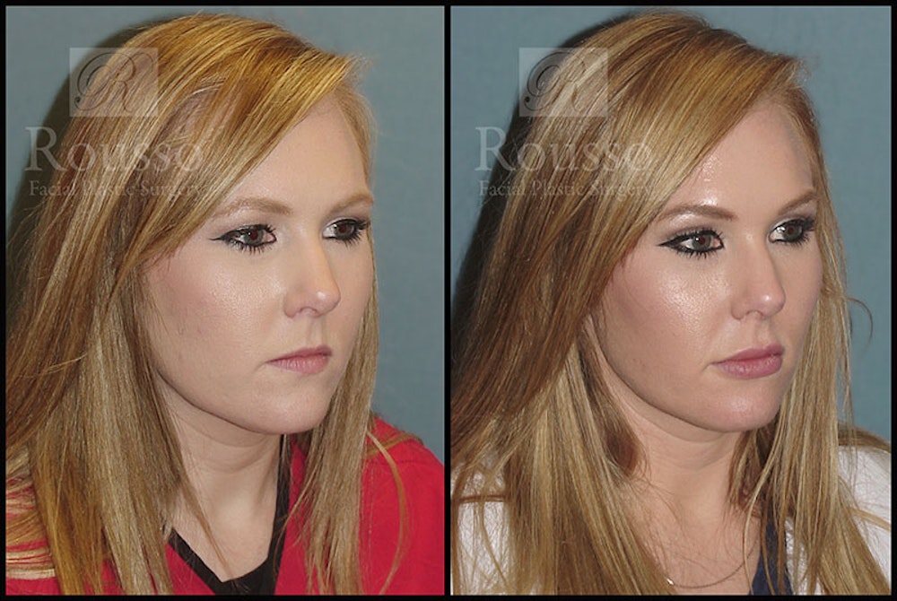 Fillers Before & After Gallery - Patient 4009382 - Image 3