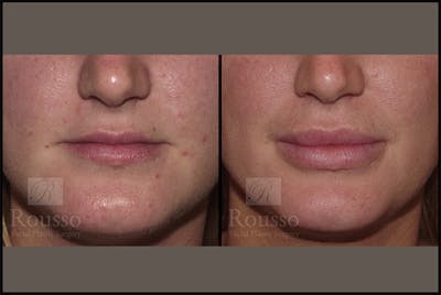 Fillers Gallery Before & After Gallery - Patient 4412631 - Image 1