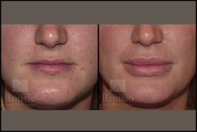 Fillers Before & After Gallery - Patient 4412631 - Image 1