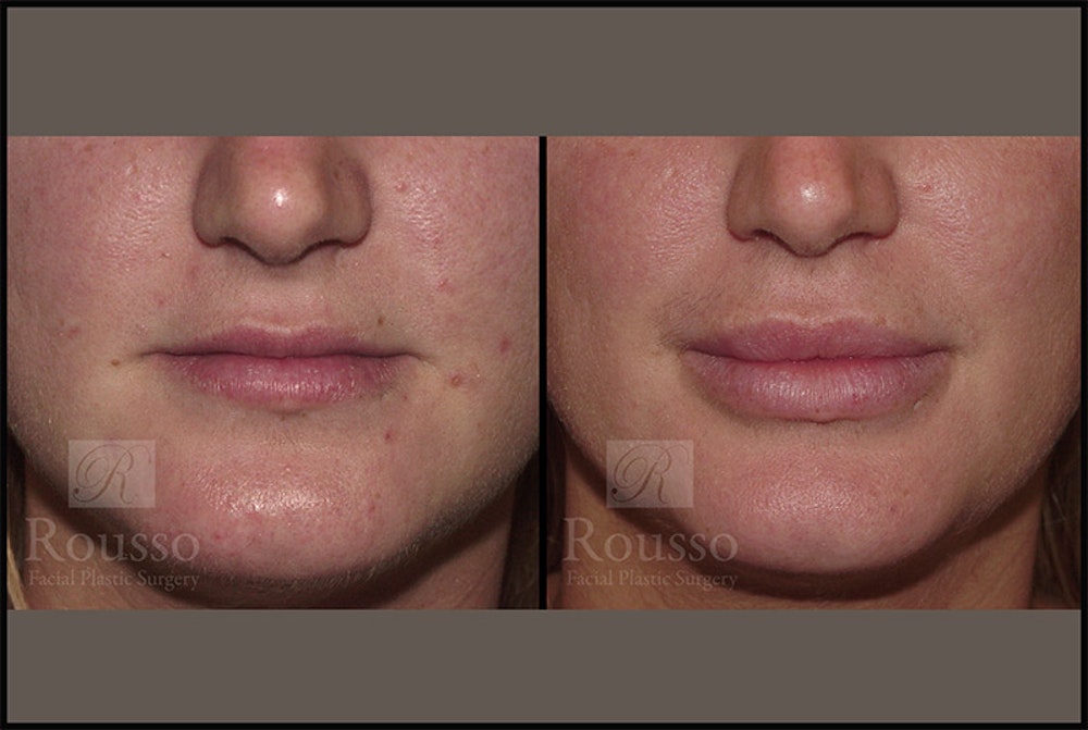 Fillers Before & After Gallery - Patient 4412631 - Image 1