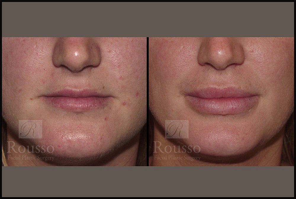 Fillers Gallery Before & After Gallery - Patient 4412631 - Image 1