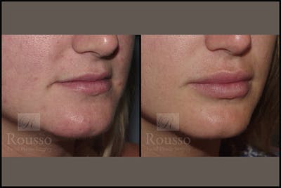 Fillers Gallery Before & After Gallery - Patient 4412631 - Image 2
