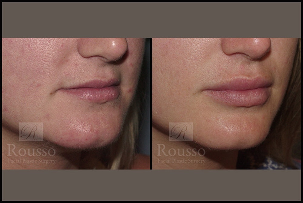 Fillers Gallery Before & After Gallery - Patient 4412631 - Image 2