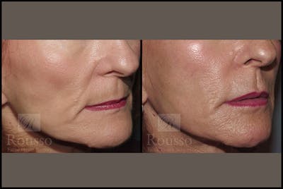 Fillers Gallery Before & After Gallery - Patient 4412632 - Image 1