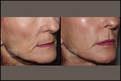 Fillers Before & After Gallery - Patient 4412632 - Image 1