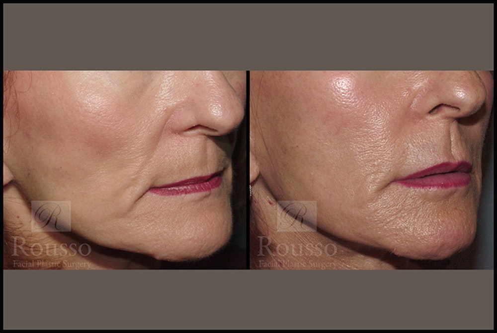 Fillers Gallery Before & After Gallery - Patient 4412632 - Image 1