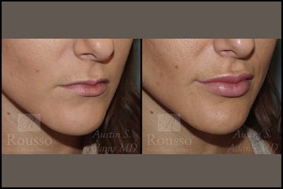 Fillers Before & After Gallery - Patient 4412633 - Image 2