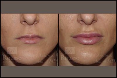 Fillers Before & After Gallery - Patient 4412633 - Image 1