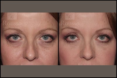 Fillers Gallery Before & After Gallery - Patient 4412634 - Image 1