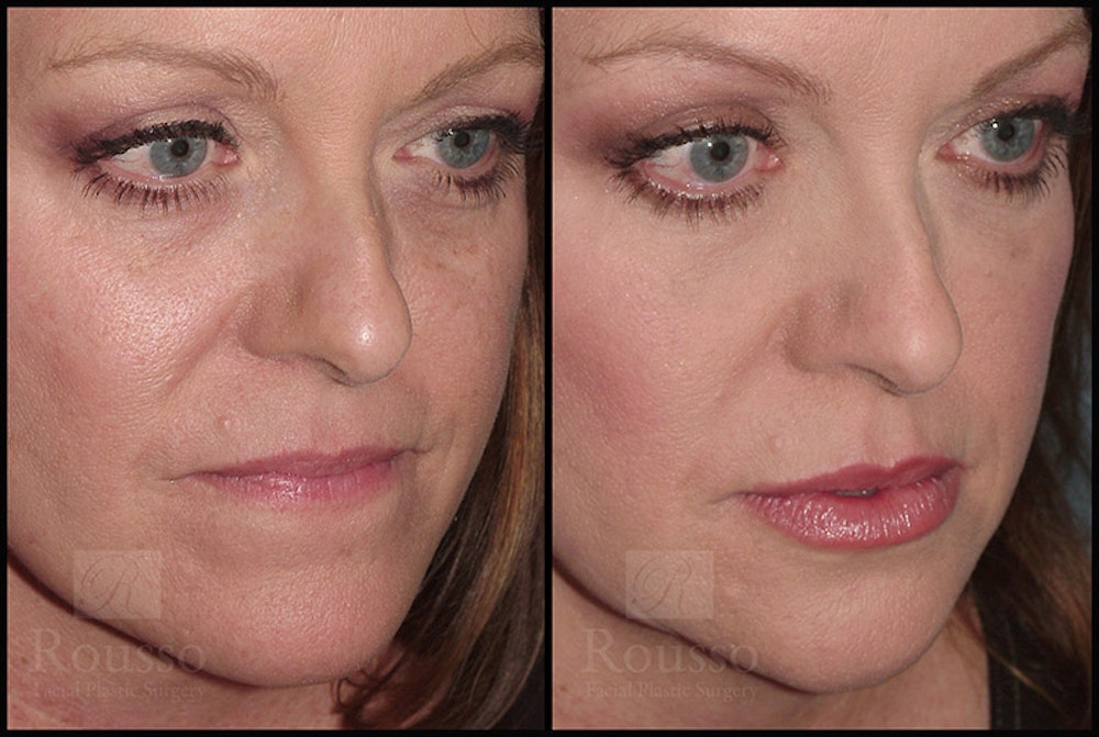 Fillers Before & After Gallery - Patient 4412634 - Image 2