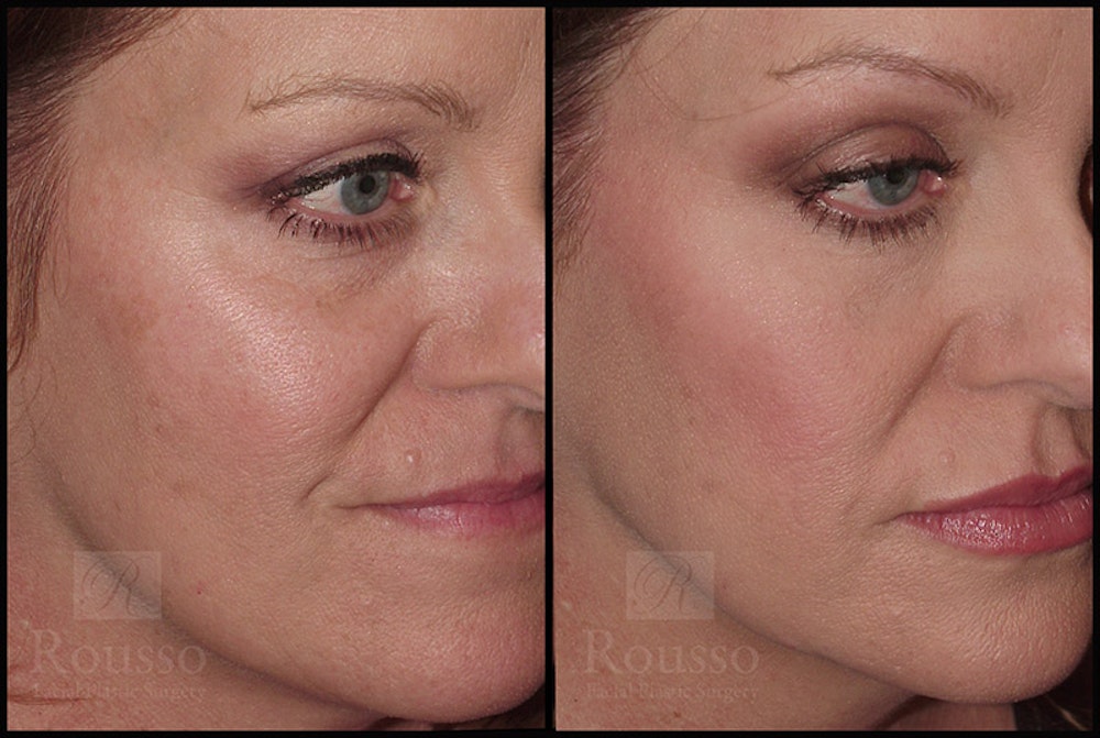 Fillers Before & After Gallery - Patient 4412634 - Image 3