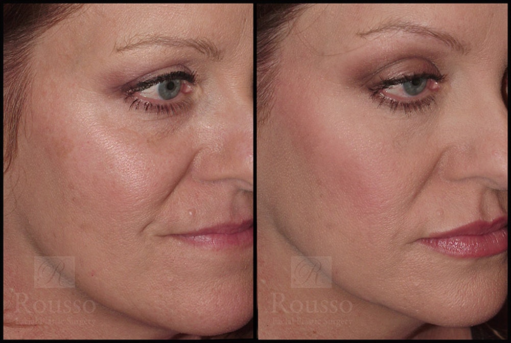 Fillers Gallery Before & After Gallery - Patient 4412634 - Image 3