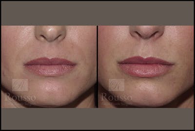 Fillers Before & After Gallery - Patient 4412635 - Image 1