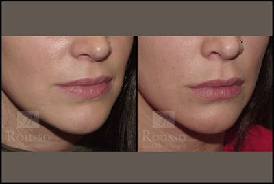 Fillers Gallery Before & After Gallery - Patient 4412636 - Image 1