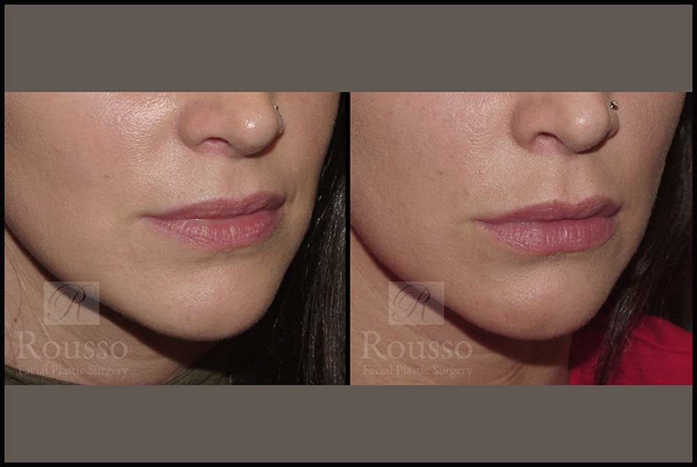 Fillers Gallery Before & After Gallery - Patient 4412636 - Image 1