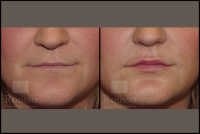 Fillers Before & After Gallery - Patient 4412637 - Image 1